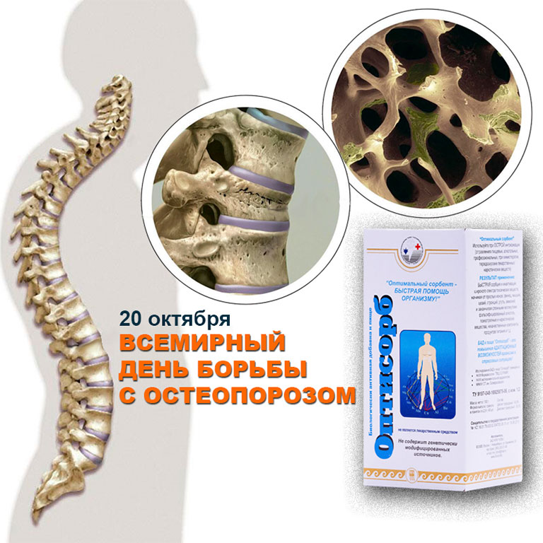 Всемирный день борьбы с остеопорозом